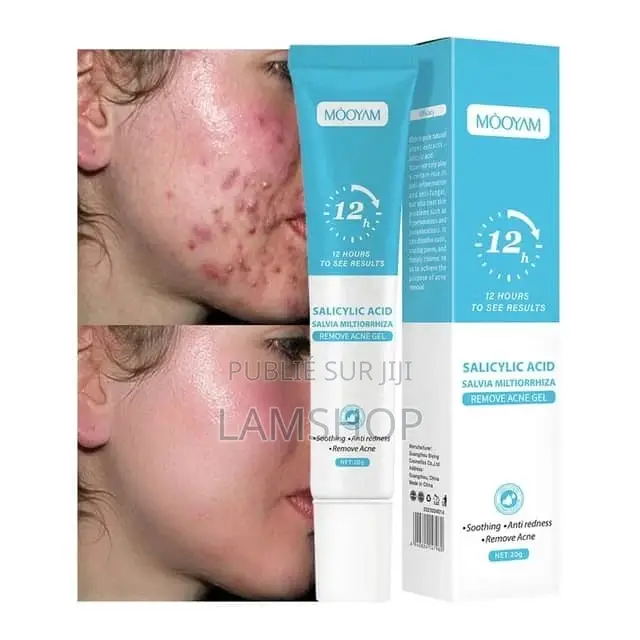 Salicylic Acid Remove Acne