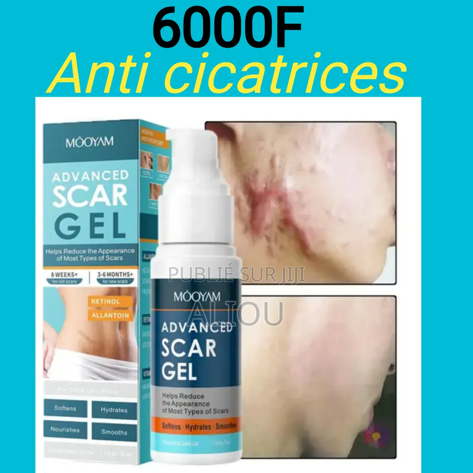 Gel Contre Les Vieilles Et Nouvelles Cicatrices