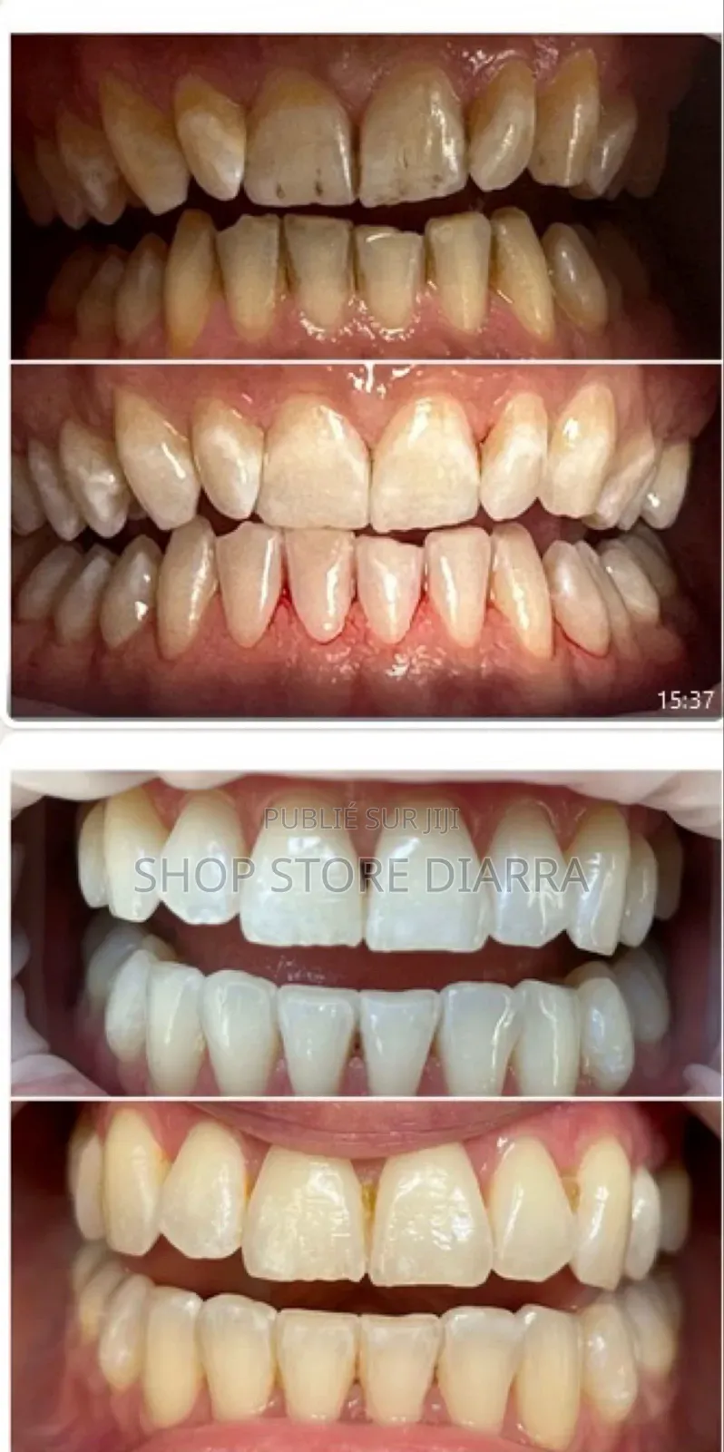 Lanthome V34 Le Sérum Violet Qui Transforme Votre Sourire En 1 Minute