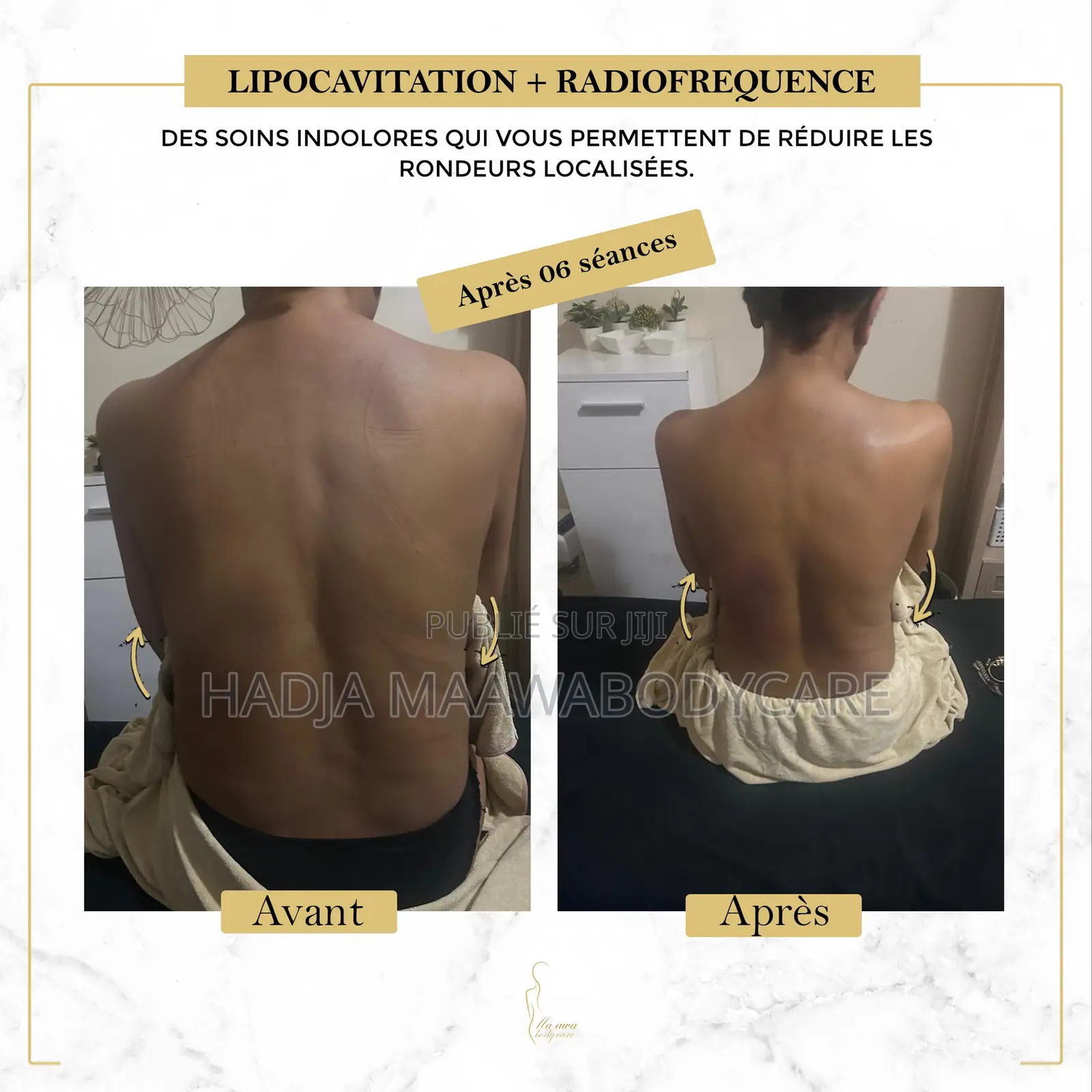 Affinez Votre Silhouette Sans Chirurgie