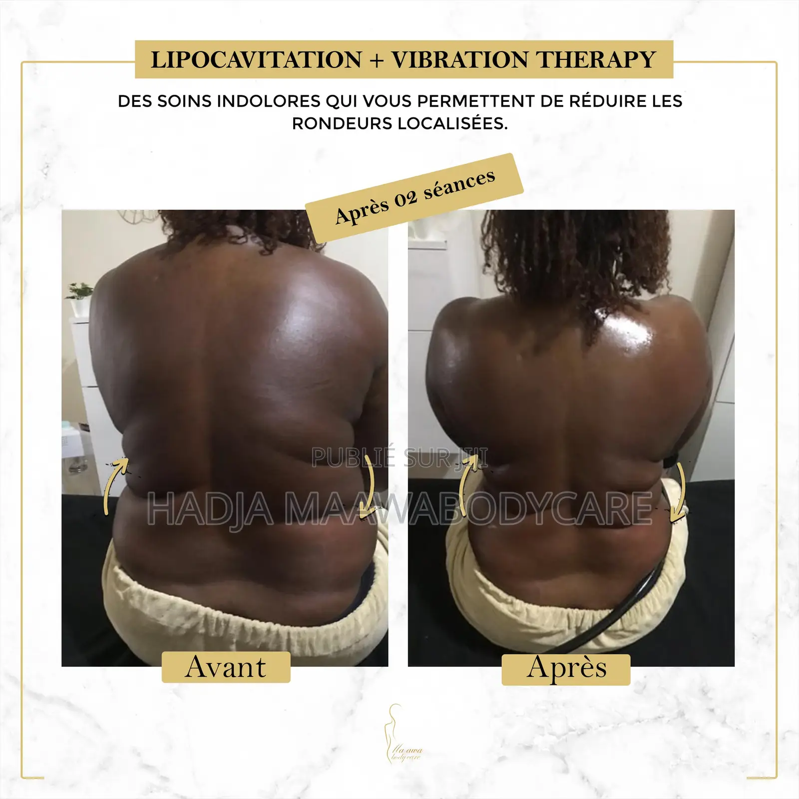 Affinez Votre Silhouette Sans Chirurgie