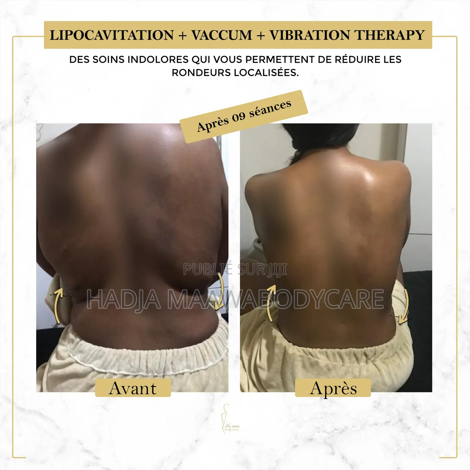 Affinez Votre Silhouette Sans Chirurgie