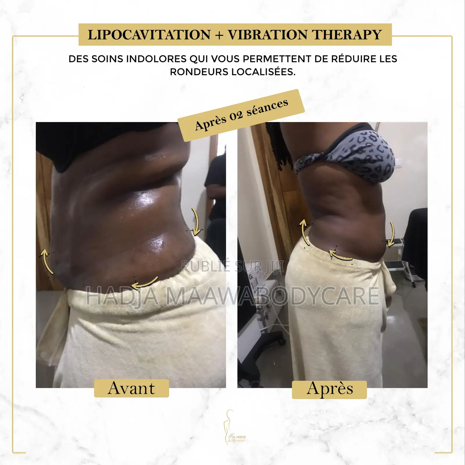 Affinez Votre Silhouette Sans Chirurgie