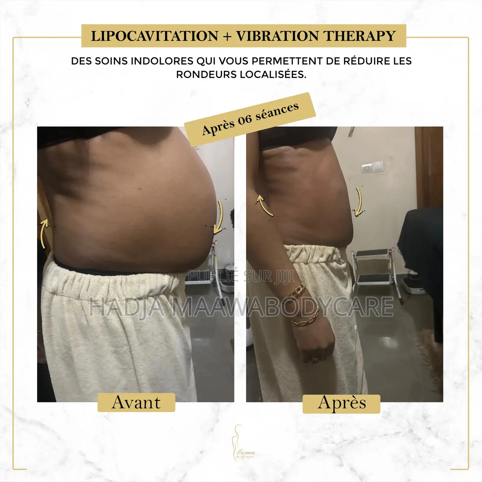 Affinez Votre Silhouette Sans Chirurgie